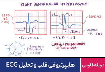 هایپرتروفی قلب و تحلیل ECG