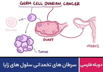 سرطان های تخمدانی سلول های زایا