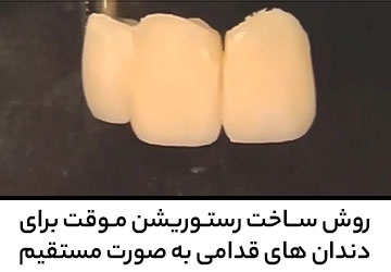 روش ساخت رستوریشن موقت برای دندان های قدامی به صورت مستقیم